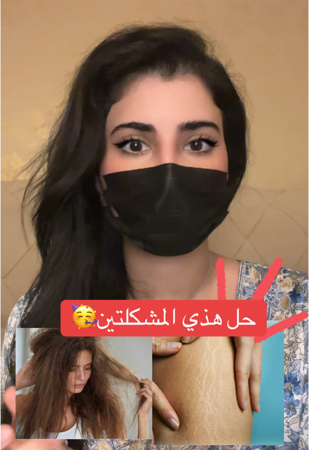 حل نفشة الشعر و الخطوط البيضاء بالجسم🥳 #fyp #advice#care 
