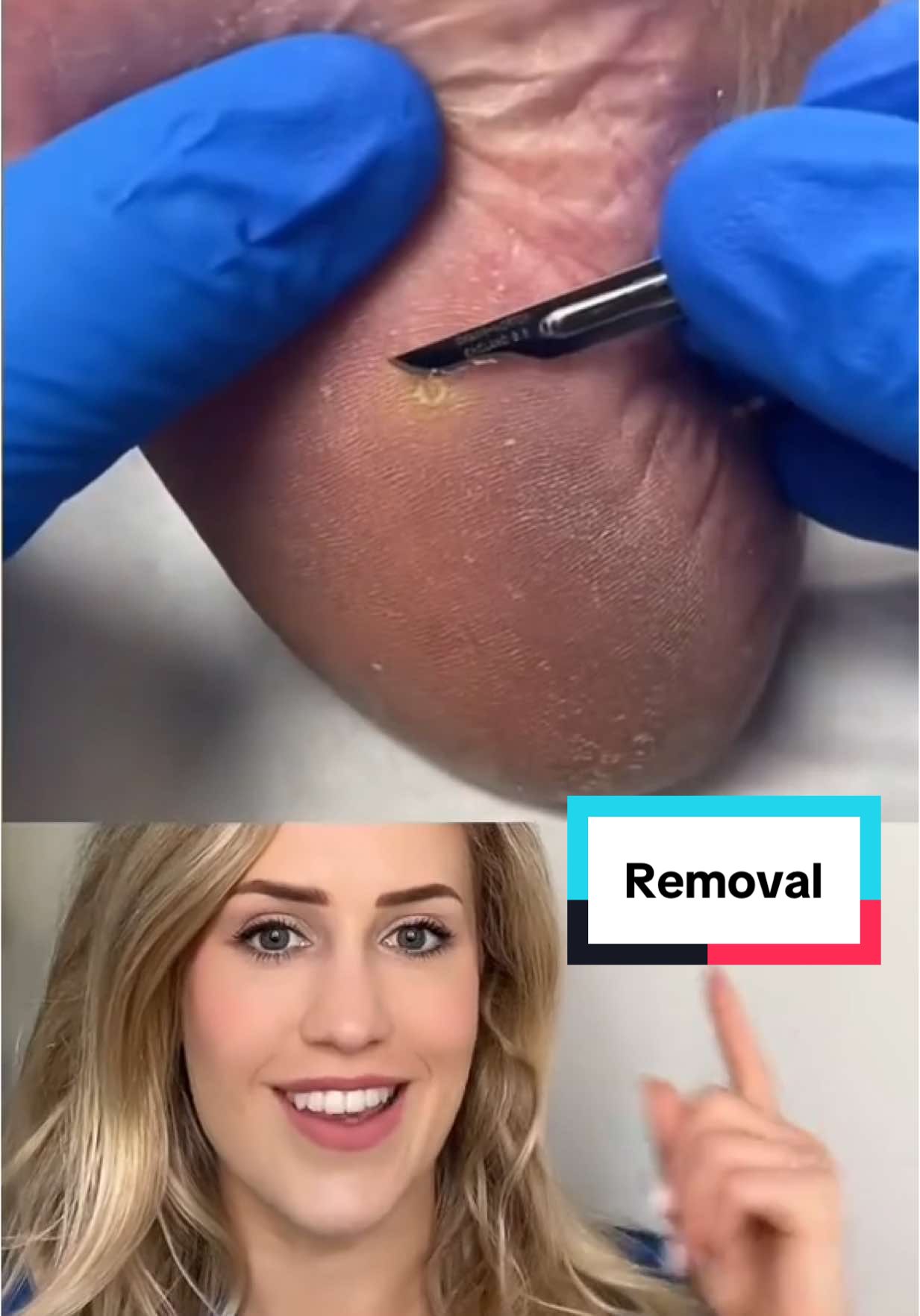 Reacting to a corn removal! VC: @ergonx   #podiatry #footdoctor #callus #doctor
