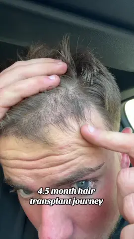 Let me talk you through my hair transplant journey @merchantcitymedicalgroup c0de alnfitness for 500 smackeroonies off it  #fyp #food #hairtransplant #pt #scottish #myprotein #gym 