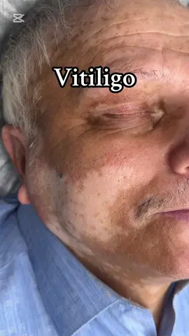 Kamuflaj vasitesi ile vitiligo ləkələri örtmek mümkündür 👌 . #vitiligo #vitiliqo #vitiliqoxesteliyi #vitiliqonunbaglanmasi #kamuflaj #камуфляжвитилиго #витилиго 