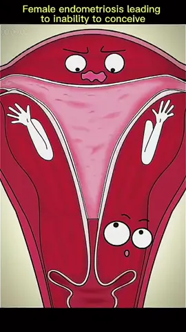 #female #endometriosis #fetal #position #reversal #pregnant #foryou #fypシ 