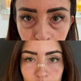 Tear trough filler before and after ♥️ 📍London #teartroughfiller#undereyebags#darkcircles#recommendations#fyp 