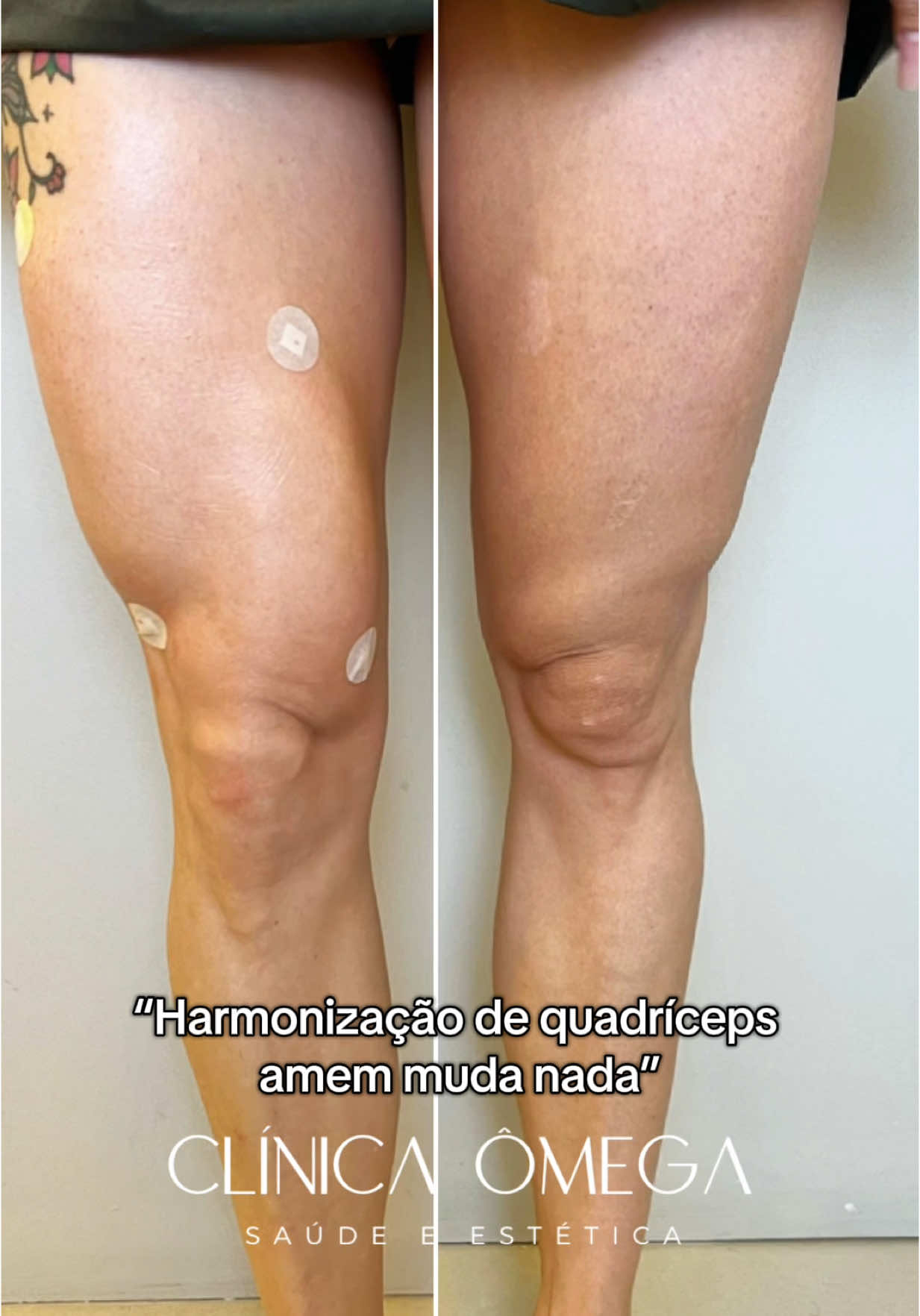 Chega de não se sentir confiante com suas pernas! A harmonização de quadríceps traz volume imediato, com naturalidade e harmonia. Um procedimento feito em consultório, com anestesia local e o melhor: VOCÊ NÃO PRECISA SE AUSENTAR DAS ATIVIDADES! 😍 - Nós não trabalhamos com nenhum material definitivo! Usamos apenas preenchedores que necessitam de manutenção.  - Cada resultado é único, não é possível garantir o mesmo a todos. É importante que a anatomia, rotina, entre outros fatores, sejam respeitados.  🩷