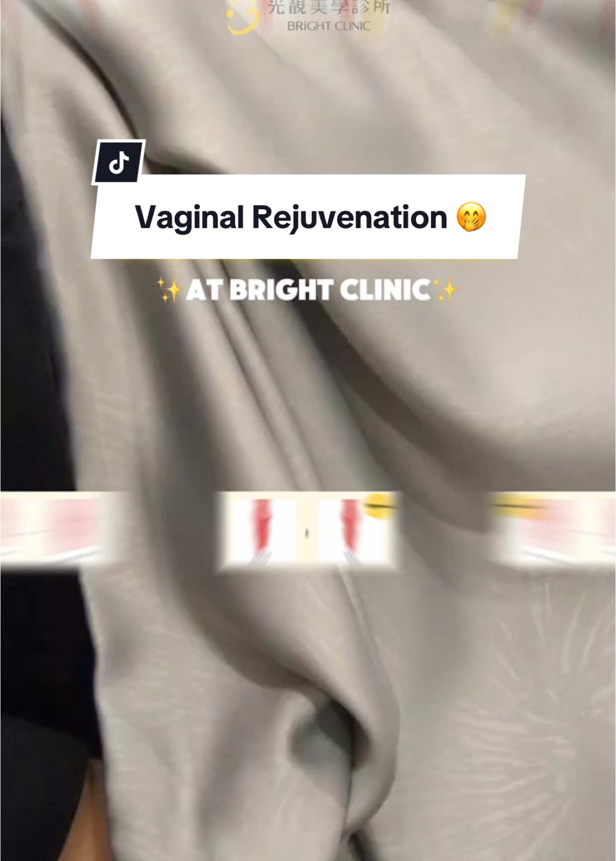 Yes we have Vag Rejuvenation at Bright Clinic 🫣 #beautyclinicintaiwan #pinoyclinictaiwan #pinoytaiwan #kaohsiungclinic #taoyuanclinic #ofwtaiwan🇹🇼🇵🇭 #pinayintaiwan🇵🇭🇹🇼 #ofwtaiwan #taiwanfactoryworker #whiteningiv #glutadrips #facialtreatment #picolaser #whiteheads #scars #intimatecare #hairremoval #botox #mesolipo #nosethread #hikonose #filipinaintaiwan #englishteacherintaiwan #pinoytiktoktaiwan🇹🇼🇵🇭 #pinoytaiwantiktokers🇵🇭🇹🇼 #brightclinic 