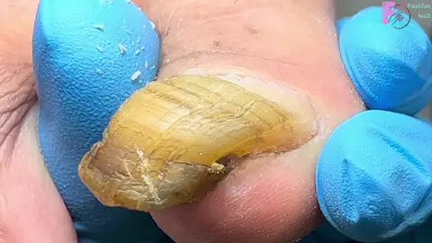 Thick Nails That Are Harder Than Stone Are So Difficult To Cut #pedicure #naildesigns #ingrownnail #nailtutorial #fungusnailstreatment #ingrowntoenail #nailart #nails #viraltiktok #nailsartvideos #fungusnails #fungus #viralvideo #viral #修脚 #trending #nailpolish #trend #toenail #nail #laykhoemongchan❤ #laykhoe #fyp #fypシ゚viral#fyppppppppppppppppppppppp