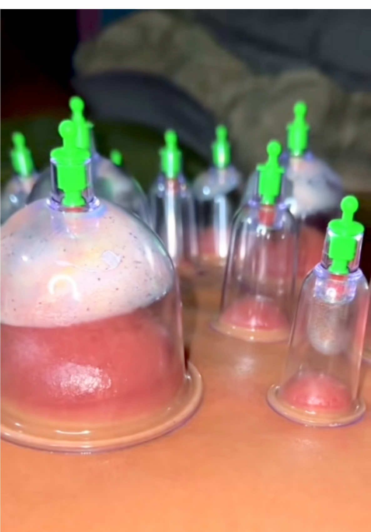 12pcs Set Ventos Cupping Therapy Vacuum Suction 🥶 #cuppingtherapy #cuppingmassage #ventosa #relaxation #theraphy #ventosa 