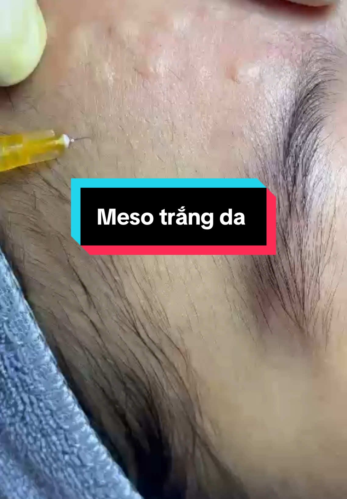 🇫🇷 TIÊM MESO CĂNG BÓNG TRẺ HOÁ DA  Nếu hỏi mình 1000 lần có nên tiêm MESO không? Thì mình sẽ luôn trả lời là YES, tiêm đi tiêm ngay.  💉1 buổi cấy Meso = 3 tháng dưỡng +  nửa năm đắp mask chăm chỉ đó ạ Ưu điểm vượt trội của liệu pháp Meso • Collagen trong tế bào da tăng 600% • Elastin trong tế bào da tăng tới 300%  • Kích hoạt tăng sinh tế bào da 80% • Giảm thiểu sắc tố 75% • Không mất thời gian nghỉ dưỡng sau liệu trình #Tiêmmesocăngbóng#xuhuongtiktok #Ngoc_spa #mesotherapy 