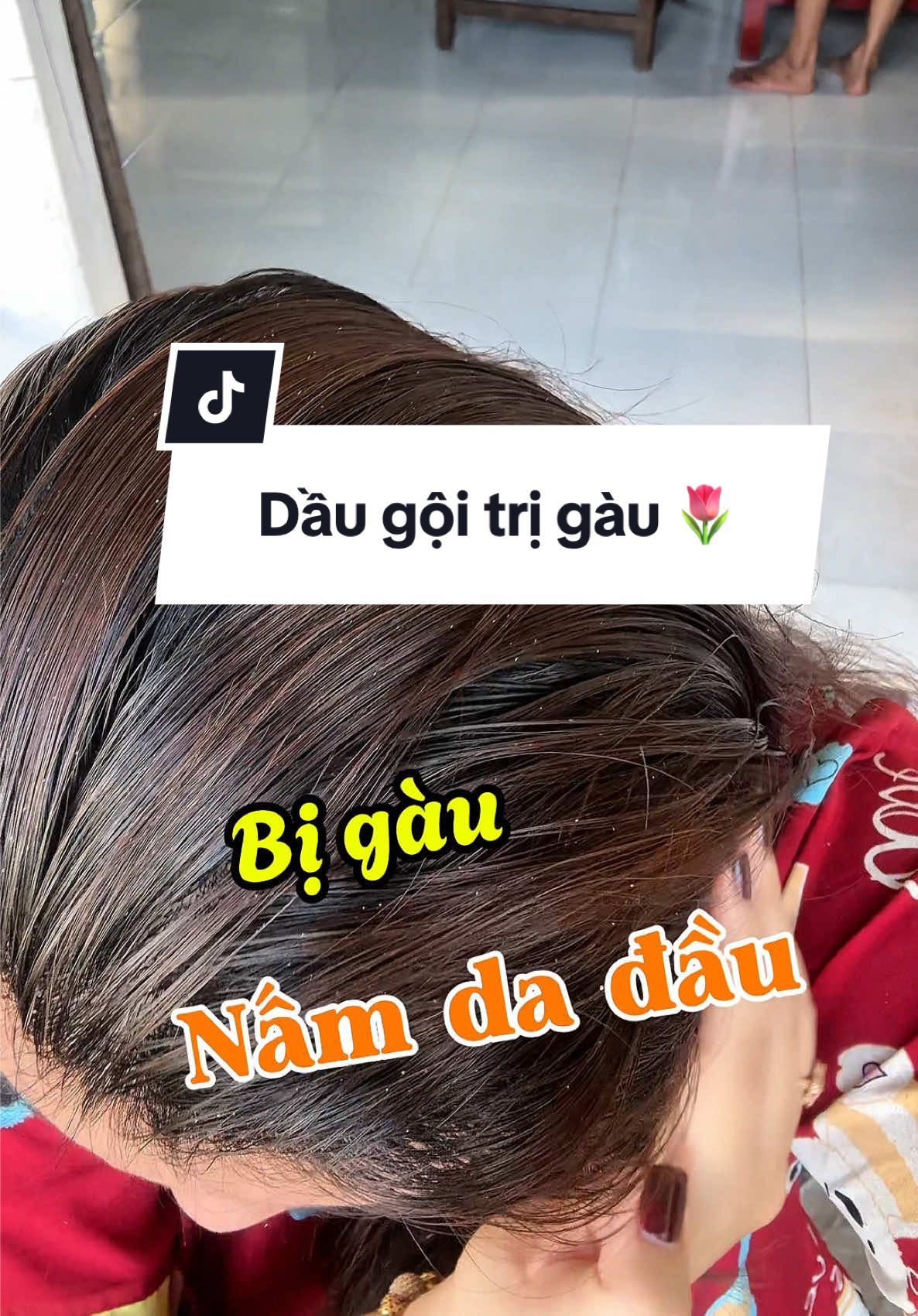 Bà nào bị Gàu, nấm da đầu, tóc dễ bết thì dùng thử Dầu Gội iCare này nha 😘  #daugoitrigau #daugoitrinamdadau #icare #icarepharma #xuhuong #fyp 