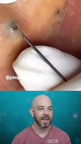 This cyst doesn’t go quietly 👀💥 You won’t want to miss it! (credit_ @pimplepoppersus on TT)  #doctor #doctorreacts #ingrown #pimple #ingrownhair #dermreacts #viral #satisfying #foryoupage
