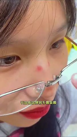 do you know marks caused by eyeglasses，can be solved with this? #glassesspacer #Myopia #Glasses #antislip #EVAspongepad #nosepads
