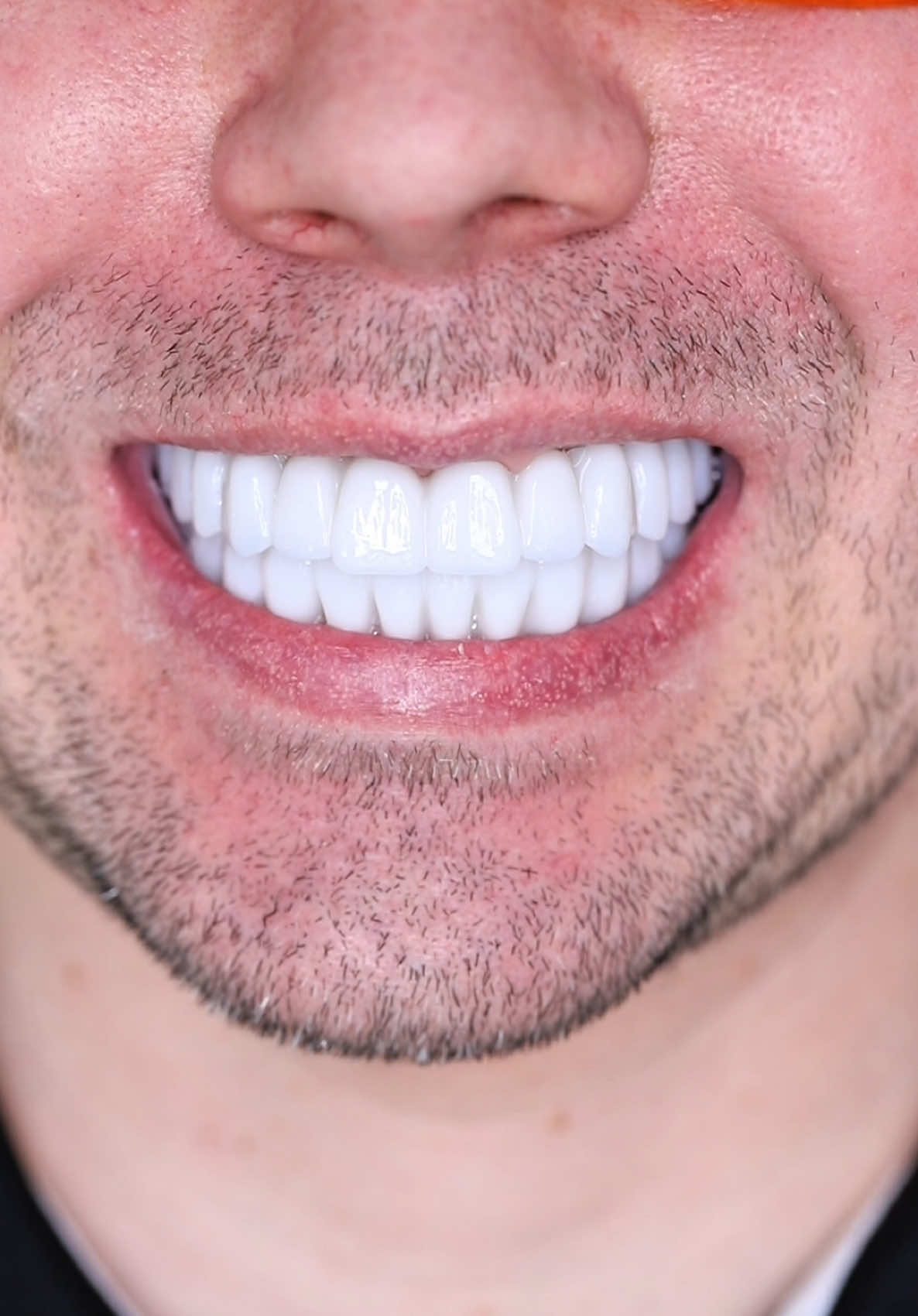 Oceňte naši práci! All-on-X na obě čelisti – co říkáte na výsledek? Chcete taky takový úsměv? Napište nám na dsmileprague@gmail.com Pošlete svůj rentgen a získejte online konzultaci ZDARMA!  Check out our work! All-on-X on both jaws – how do you like the result? Want the same smile? Write to us at dsmileprague@gmail.com Send your X-ray and get a FREE online consultation!  #stomatologie #implantáty #allonx #novýúsměv #dsmile #praha #zubníimplantáty #allonzuby #dentistry #implants #allonx #smiletransformation #dsmile #prague #dentalimplants #allon4 #allon6 #dsmile #prague #implants #surgery #teeth #newsmile 