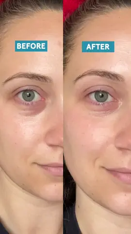 @Peter Thomas Roth Labs Peptide Skinjection fill+fix under eye cream is an every day staple for me to help my hallow under eyes and dark racoon circles! Legit under eye filler without the needle!!. #ptrbeforeafter #peterthomasroth #skinjection #undereyecircles #darkundereyes 