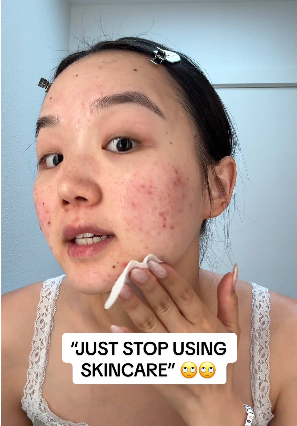 I wish it was that easy🤧🥲 #acne #hormonalacne #acnetips #unsolicitedadvice #acneskincare #skincare #relatable #clearskin 