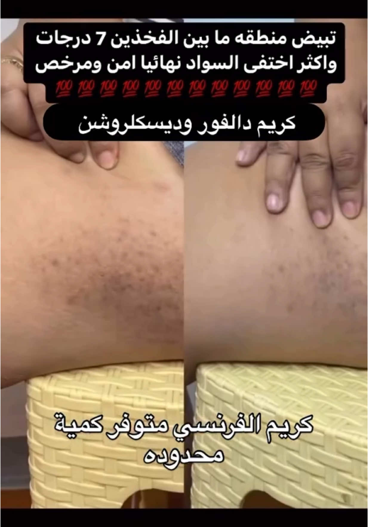 لتفتيح الأماكن الداكنة #تفتيح_المناطق_الداكنة #تفتيح #عرايس #fypシ #foryou #viral #explore 