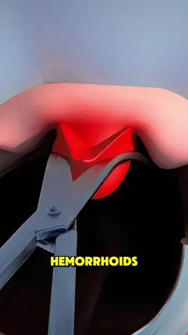 Hemorrhoidectomy #surgery #hemorrhoids #henorrhoids #hemorrhoidsurgery #hemorrhoidectomy #hemorrhoidssuck #hemorr #hemorroidas #hemorrhoidtreatment #hemorroidesexternas #hemorrhoidscheck #hemoroizi #hemorrhoidcream 