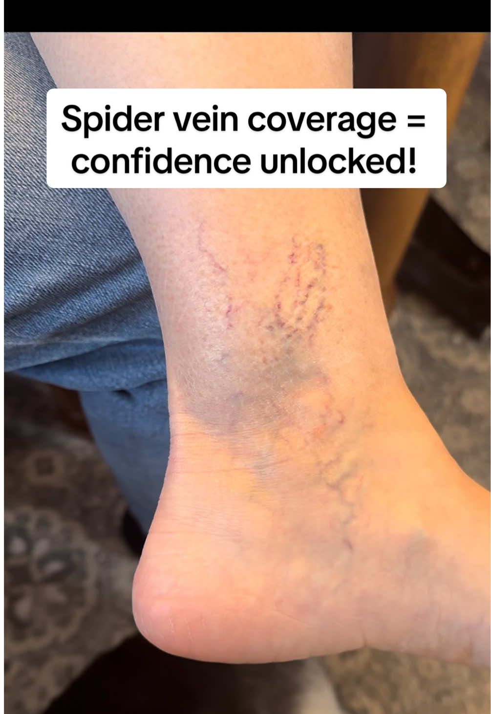 My mom hasn’t worn a dress in years... then she tried this and said “I think I’ll wear a dress this weekend.” 🥹 body coverage makeup = confidence unlocked 💅✨ #BodyMakeup #TikTokMadeMeBuyIt #WestmoreBeauty #SummerGlowUp #ConfidenceHack #SpiderVeins #TikTokShopFinds