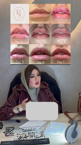 #CapCut معلومات بعد الحقن  #اكسبلور #فلر #تجميل_الوجه #بنات_تيك_توك #الشعب_الصيني_ماله_حل😂😂😂 #foryou #fyp #بنات_تيك_توك #اكسبولوررررر #بنات_العراق #حسحس #explore #exp 