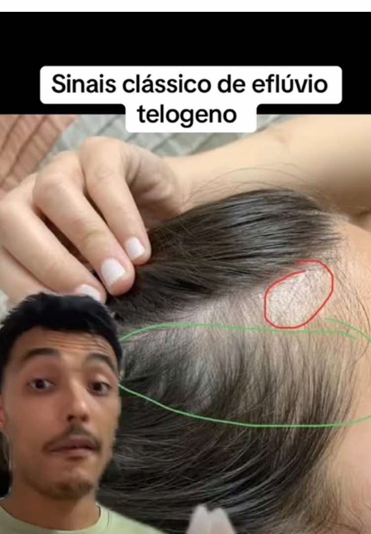 Afinamento difuso e falhas nas regiões laterais são características comuns do eflúvio telógeno — uma condição marcada pela queda acentuada dos fios devido a desequilíbrios no ciclo capilar. O diagnóstico precoce é essencial para o tratamento eficaz. #quedadecabelo #falhanocabelo #afinamentocapilar #crescimentocapilar #efluviotelógeno #tricologia 
