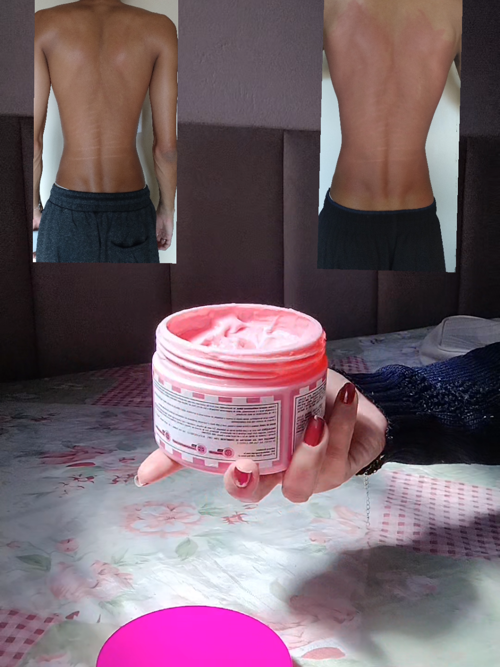 Usei o creme rosa nas costas do meu irmão… o antes e depois chocou!  #estrias #cremetermogênico #estriasbrancas 