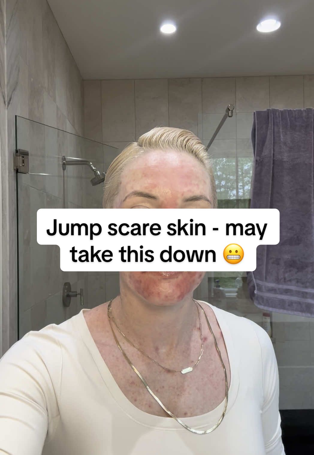 GRWM with red splotchy skin… wanted to share some make up tips and tricks… Hope this is helpful to others out there going through something similar!    #makeuptutorial  #skin #acne 