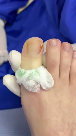 Matricectomia, solución para uñas incarnadas! #paratii #fyp #viral #podologo 