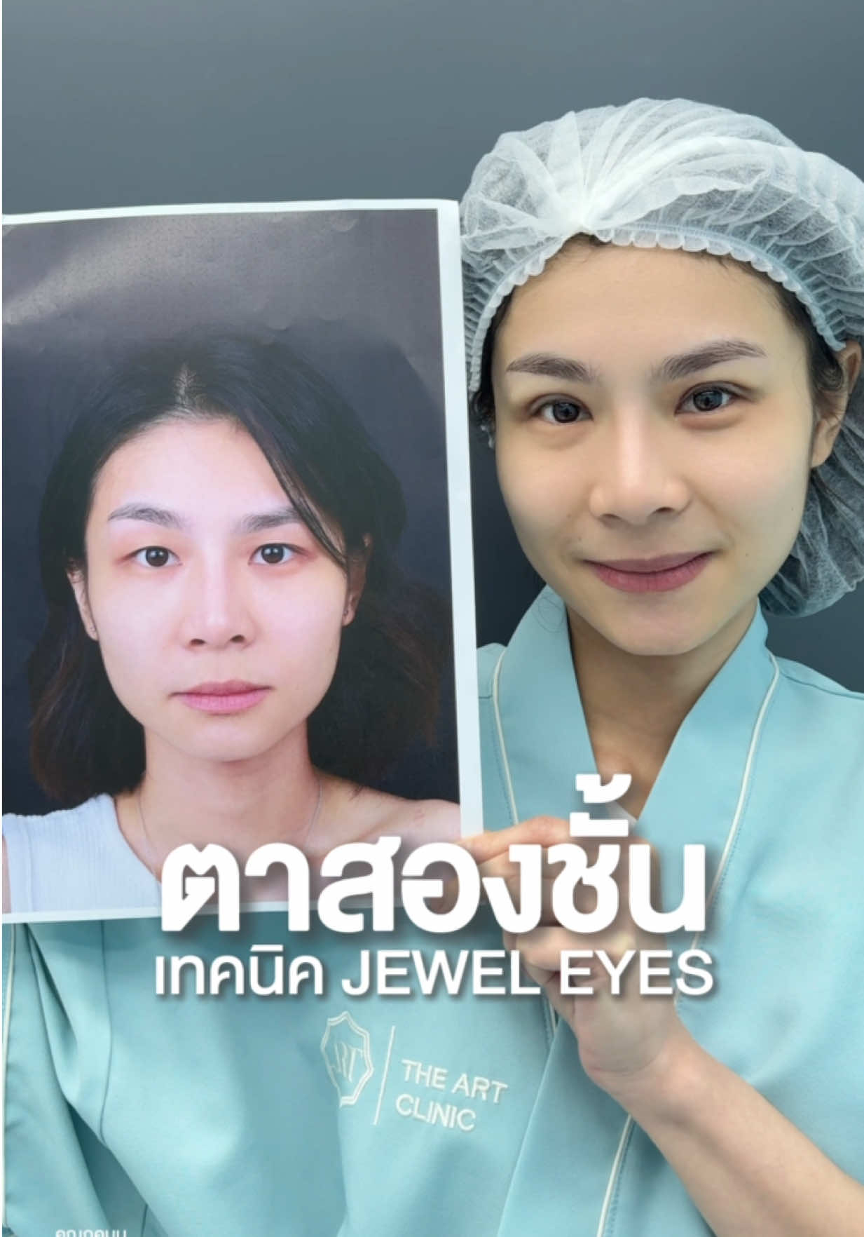 ความรู้สึกหลังเห็นชั้นตา หลังทำศัลยกรรมตาสองชั้น เทคนิค Jewel eyes ✨👀   #TheArtClinic #ดิอาทคลินิก #ศัลยกรรมตาสองชั้นดิอาทคลินิก #ศัลยกรรมตา2ชั้น #ตาสองชั้น #รีวิวตาสองชั้น 