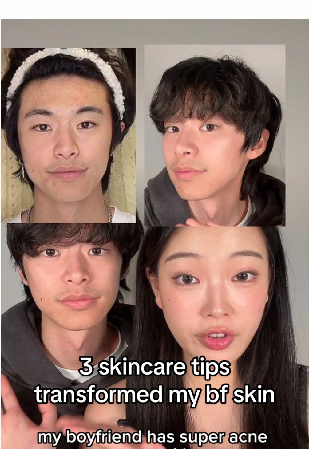 3 skincare tips that literally changed my bf's acne prone skin!! #acneproneskin #koreanskincare #kbeauty #skincare #menskincare #acne 