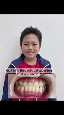 Quá trình tháo mắc cài sẽ như nào , cùng xem các bước tháo mắc cài nhé#niengrang #braces #khớp_cắn_ngược #hưng_yên 