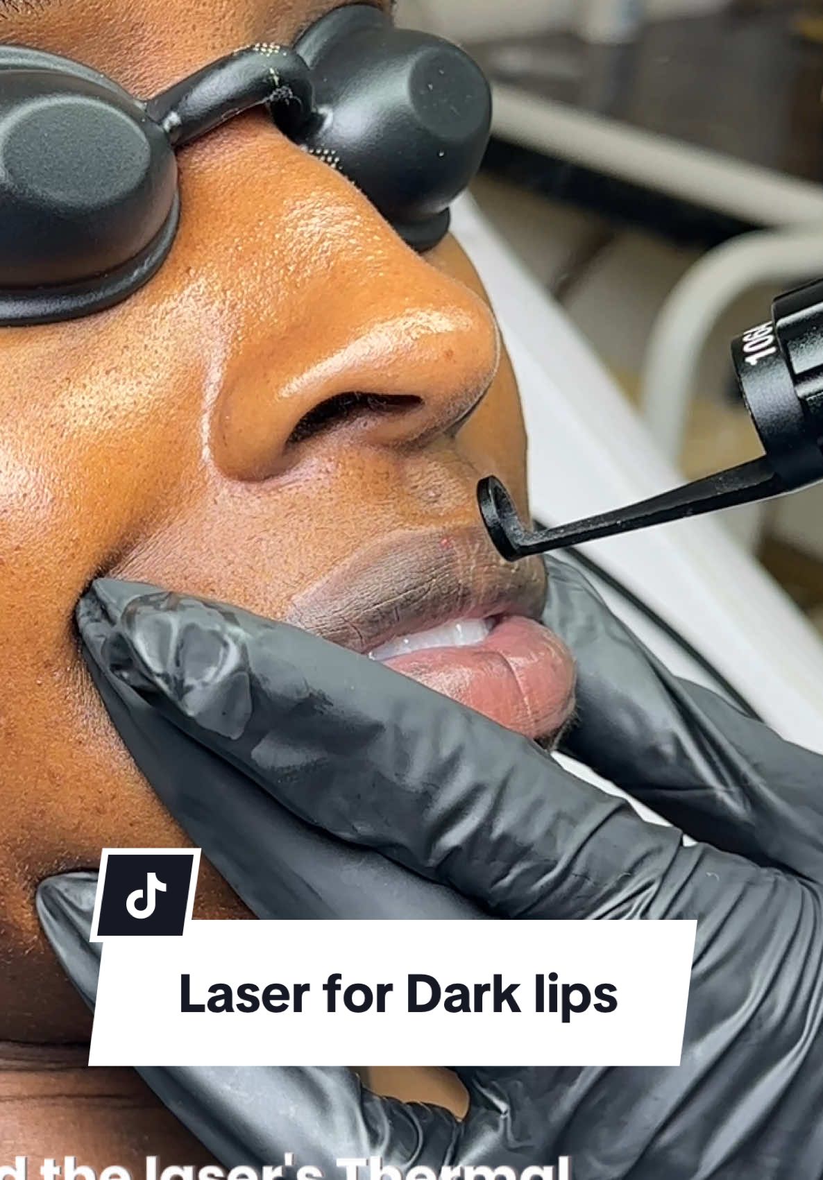 PICO laser for dark lips at @Mysa Medical & Wellness Spa 🩷