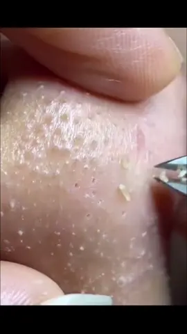 Alat pembersih komedo #Alatpembersihkomedo 