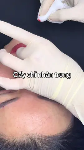 Combo hôm nay: thắt nọng cằm , cấy chỉ trán, cấy chỉ thái dương , xong rùi mê quá cấy chỉ cơ mắt Shanghai ...... Nhấn luôn form mí Shanghai ( khúc này tui cản rùi nhé k làm nữa đuối rôi) . ......... cái Pả tính toán chắc còn tiền quất luôn mũi thanh collagen, chưa xong nha tiếp tới cấy chỉ nhân trung nè ( chắc nghe nói nhân trung sâu nhanh giàu hay sao áh) bắt tui nhấn nhân trung luôn. Thiệt là ôm ca này 6 tiếng 8 dịch vụ 🥹🥹🥹