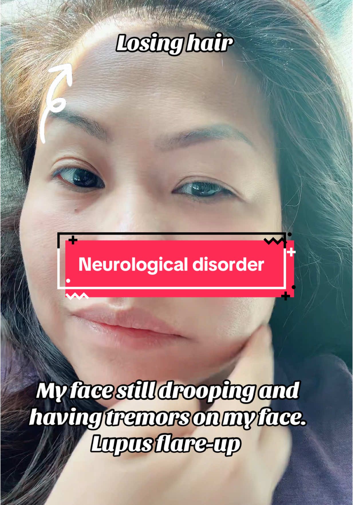 I struggle with drooping on my right side of my face every day💔💔. It just comes and goes, but yesterday was a new onset of symptoms. I have severe pain in my right eye, which feels like stabbing it, and I have blurred vision. I also have a headache and feel nauseated. My blood pressure is high, at 188/108. I’m lucky that I work at the hospital during this happened. The doctors said everything is normal and it’s not a stroke or Bell’s palsy. It’s just my lupus flaring up, and they’ve prescribed me high doses of prednisone to slow down my symptoms. #neurologicaldisorder #neurologicalcondition #lupus #lupuswarrior #lupusawareness #bellspalsy #lupusstruggles #hairloss #chronicillness #chronicillnessawareness #awareness 