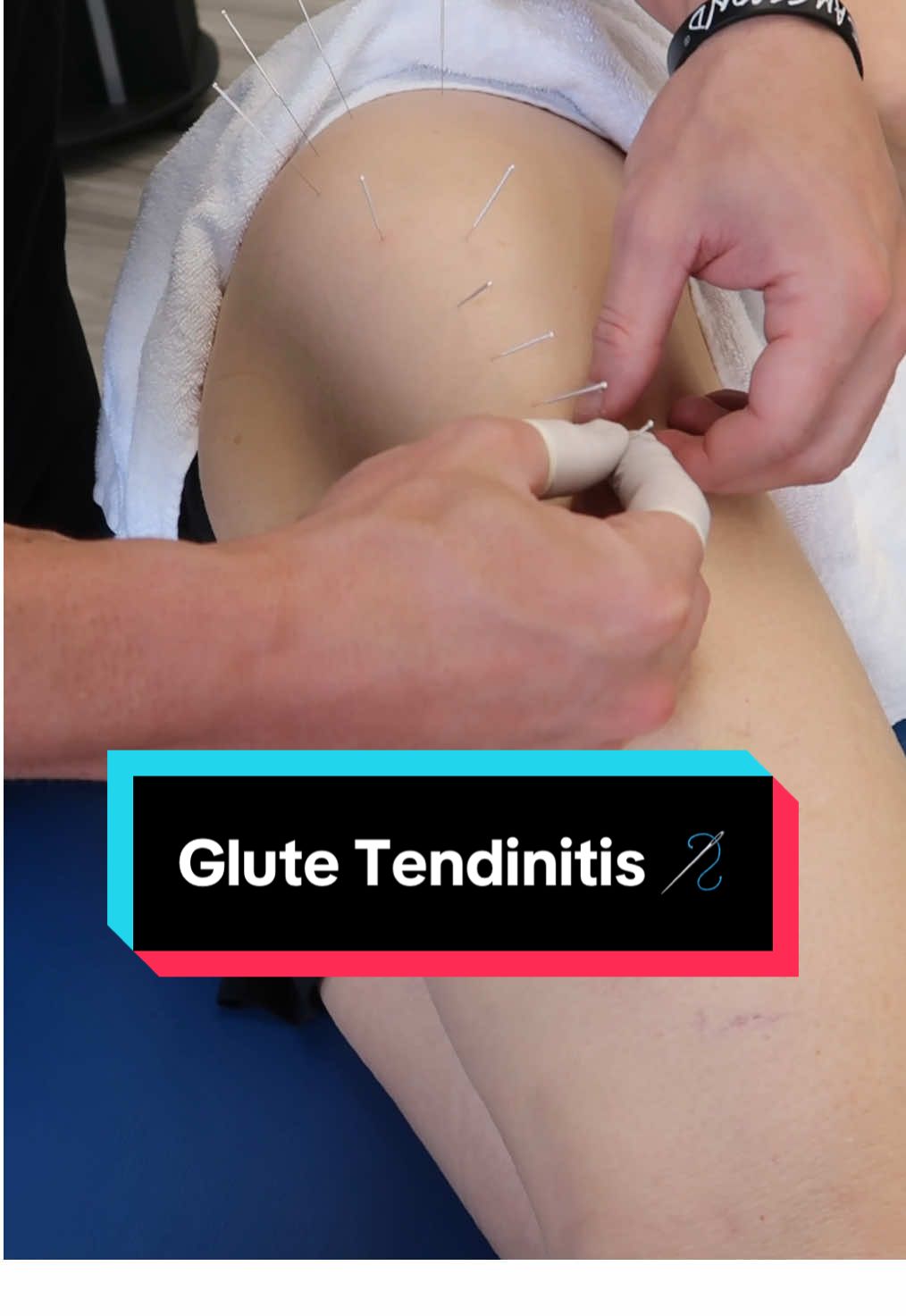 Treating glute tendonitis flare-ups with dry needling to help speed up recovery. 🪡 Schedule a Free Consultation:  📞 623.208.7575  🌐 impactptaz.com . . . #glutetendinopathy #dryneedlingtherapy #dryneedling #physicaltherapy #physicaltherapist 