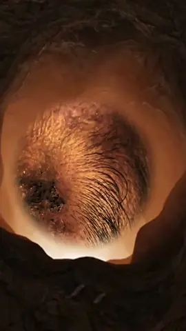 #satisfying #pimpleremover #satisfyingvideo #satisfyingvideo #pimple #squeezeyuk #fouryou #ance #relax 