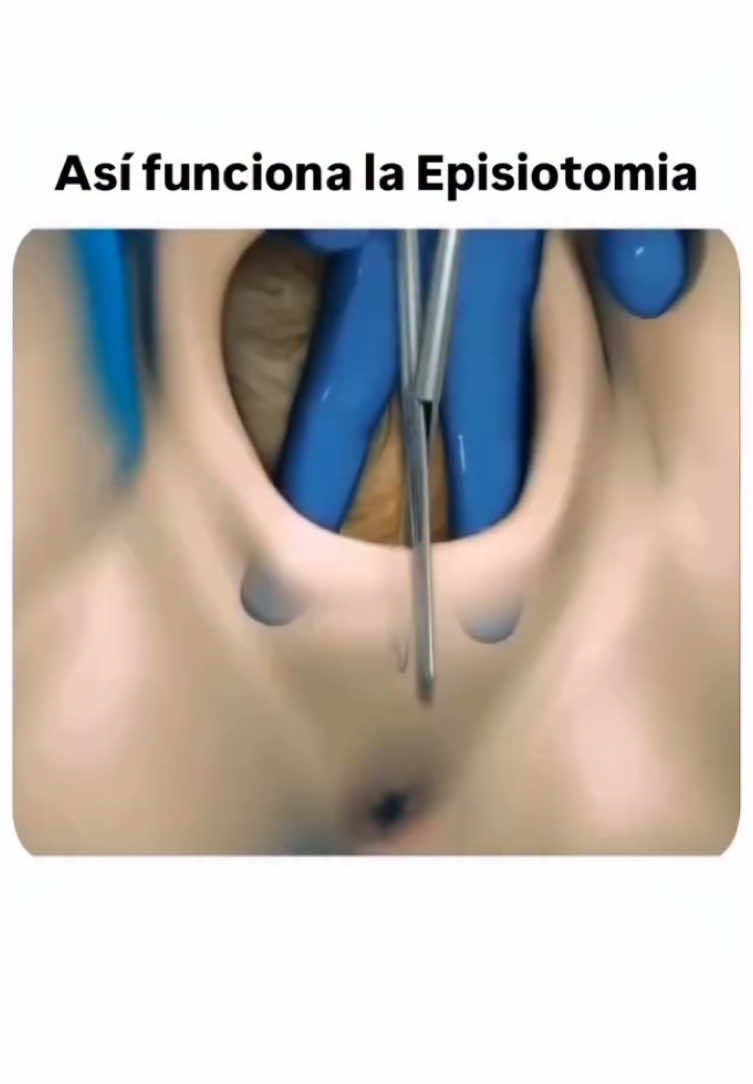 Así funciona la Episiotomia #medicina #biomedicina #salud #embarazo 