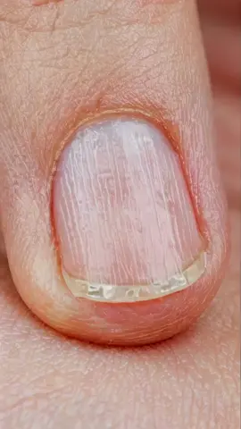 Fingernail fiasco