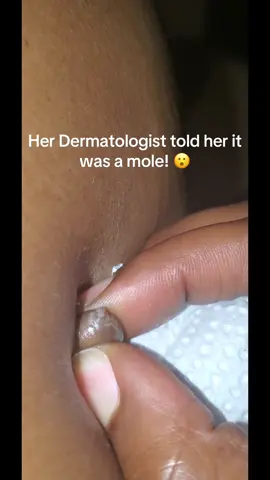 That don’t look like a mole to me! 😭 - Unknown creator, please tag if know!  - #dermatologist #cyst #skincare #pop #asmr #fyp #pimplepop #squeeze 