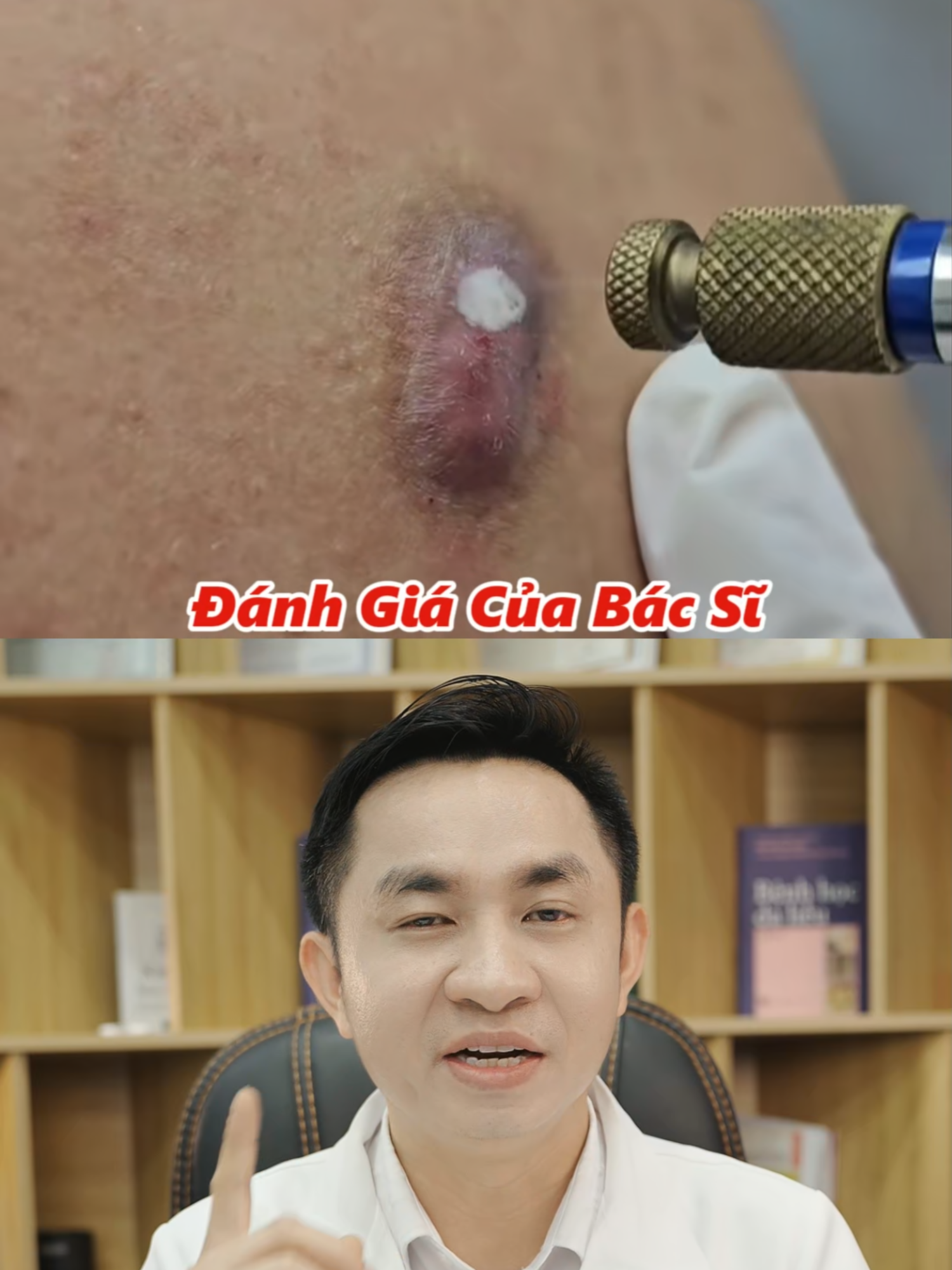Dùng Nito lỏng để loại bỏ sẹo ???  #hoangdongclinic #bacsydong #bienchungthammy #seoloi #viral