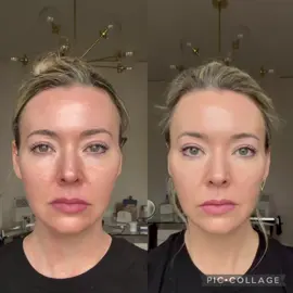 @The Aesthetic Haus 2 weeks after Botox 🤩 I do full face and jawline with upper portion of platysmal bands plus masseter. Dosing every 3.5 months trying to get to 4 🥴 but I hate movement and I’m 40 so 🤷🏼‍♀️ adding in enhanced Microneedling this week to build that collagen 🤩 #jawline #botox #lowerface #massetterbotox #facialexpressions #beforeandafter #proaging #thisis40 