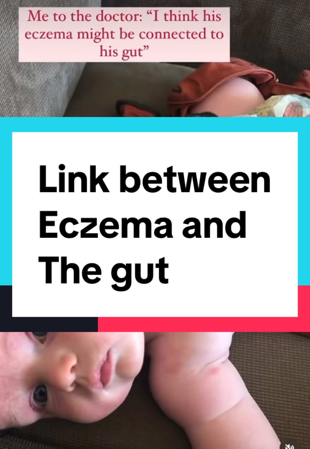 Did you know? Eczema and eosinophilic gastrointestinal diseases (EGIDs) like eosinophilic esophagitis (EoE) are both linked to allergic inflammation. If your skin reacts, your gut might be too. It’s all connected! #EczemaAwareness #EGID #EoE #AllergicDisorders #ChronicIllnessEducation #guthealth #eosinophilicesophagitis #eczema #autoimmunedisease #asthma #foodallergies original video by @emilymariedrage 