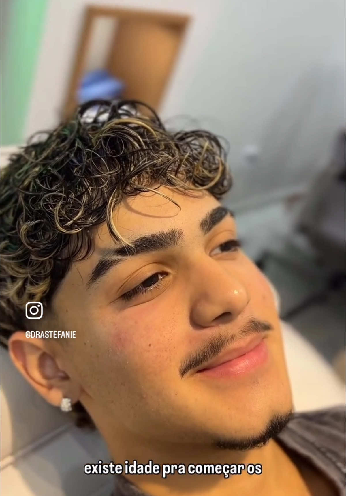 Existe idade certa para começar os cuidados? Não! Existe indicação! A harmonização é feita para realçar a beleza natural, respeitando cada fase da vida. Neste paciente de 16 anos, tratamos as olheiras de forma segura e personalizada. O resultado? Um olhar mais leve, confiante e natural! ✨ #Olheiras #HarmonizaçãoFacial #BelezaNatural #CuidadosComAPele #ProcedimentoSeguro #EstéticaResponsável