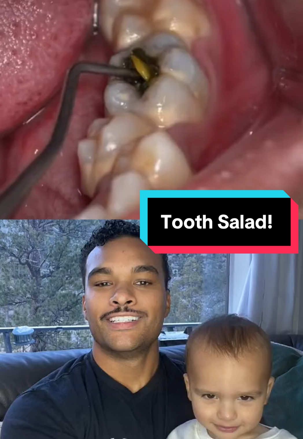Massive cavity,, legit pulled an entire salad out of his tooth #mrpopalot 