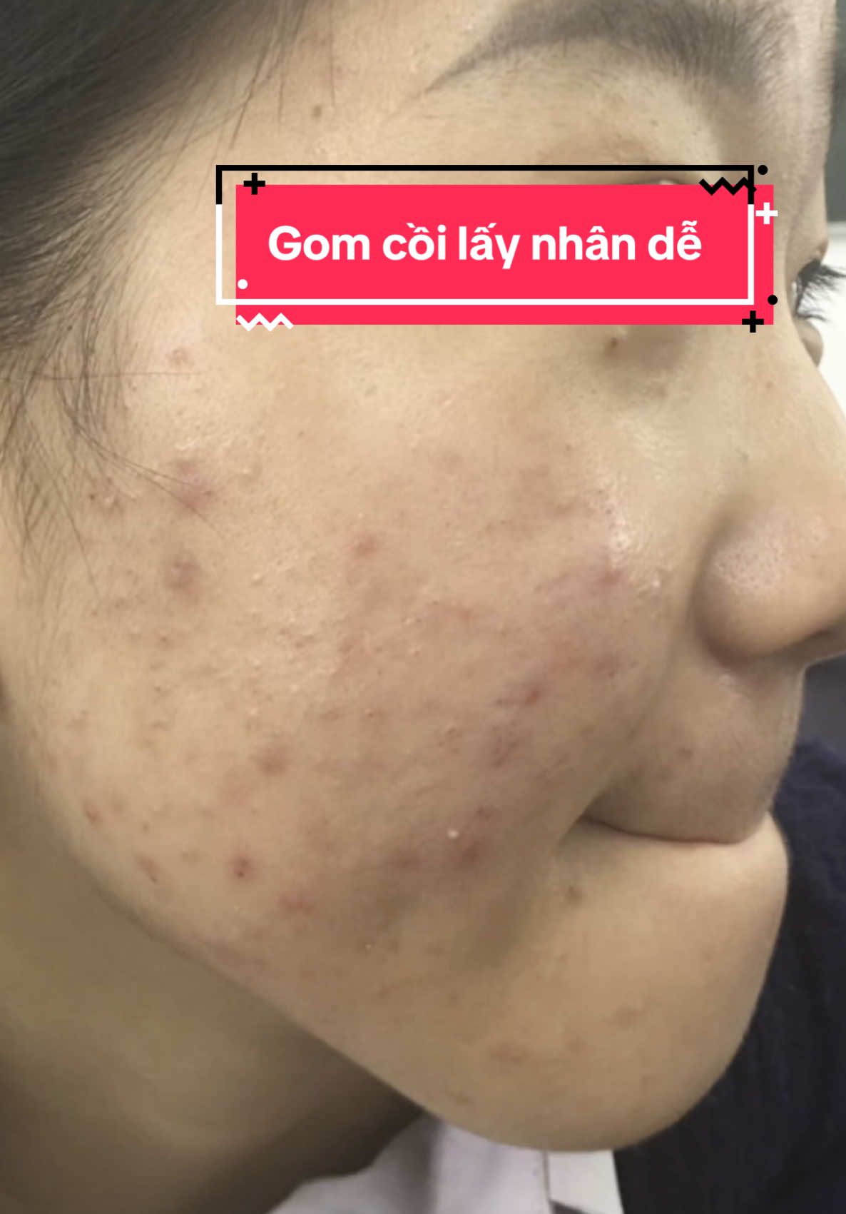 #gomcoimunsau3den10ngay #gomcoimun24h #serummunbenus #tinhchatgomcoimunbenus 