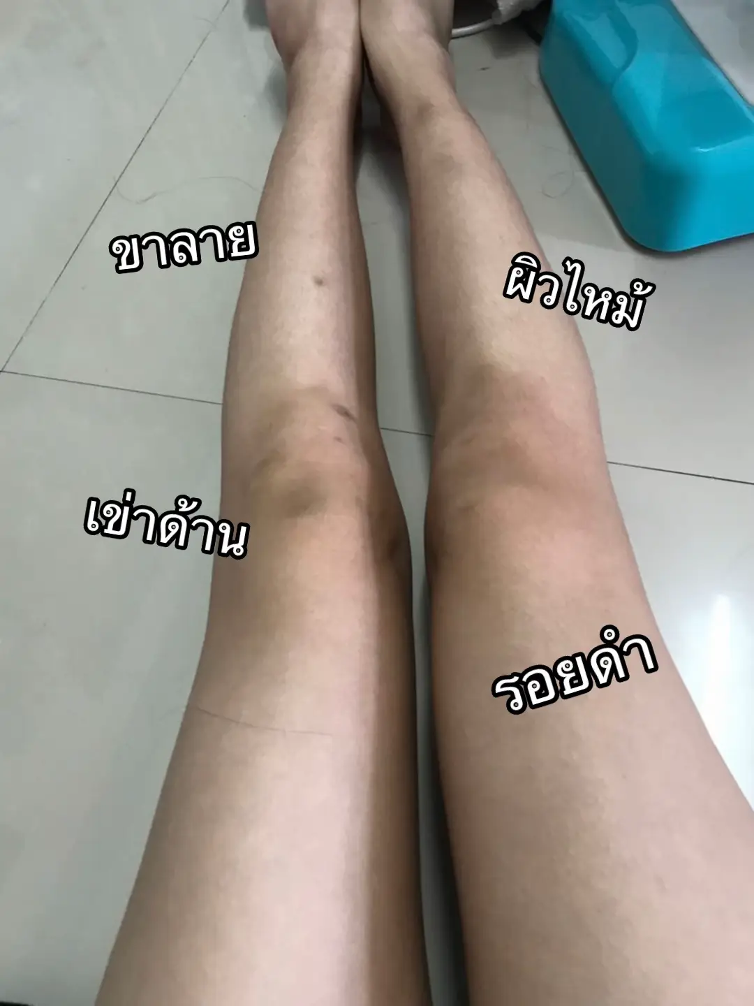 ขาวยากแนะนำเบยย กู้ผิวเสียดีมาก🫶🏻#เรตินอลสูตรอ่อนโยน #ครีมทาผิวขาว #รักษาผิวไหม้แดด #ครีมขาวแรง #ครีมเรตินอล #ครีมผิวขาว 💘#เรตินอลผิวกาย