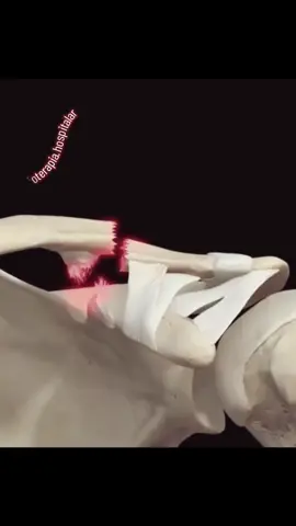 A luxação acrômio-clavicular ocorre quando há separação entre a clavícula e o acrômio (parte da escápula) na articulação acrômio-clavicular, localizada no ombro. Classificação Baseada no grau de lesão dos ligamentos: 	•	Grau I: Entorse leve (lesão parcial do ligamento acrômio-clavicular, sem deslocamento). 	•	Grau II: Ruptura completa do ligamento acrômio-clavicular e estiramento do ligamento coracoclavicular (pequeno deslocamento). 	•	Grau III: Ruptura completa dos ligamentos acrômio-clavicular e coracoclavicular (grande deslocamento). 	•	Graus IV, V e VI (menos comuns): Luxações mais graves, com deslocamento posterior (IV), superior (V) ou inferior (VI) da clavícula. Requerem cirurgia. Causas 	•	Trauma direto sobre o ombro (ex: queda sobre o ombro em esportes como futebol, ciclismo, luta). 	•	Queda com braço estendido. 	•	Acidentes de trânsito. Sintomas 	•	Dor intensa no ombro. 	•	Inchaço e deformidade visível (“degrau” no ombro em lesões mais graves). 	•	Dificuldade para mover o braço. 	•	Sensibilidade ao toque sobre a articulação. 	•	Fraqueza no ombro. Tratamento Depende da gravidade: 	•	Grau I e II (tratamento conservador): 	•	Repouso (uso de tipoia por 1 a 3 semanas). 	•	Gelo local nas primeiras 48 horas. 	•	Analgésicos e anti-inflamatórios. 	•	Retorno gradual às atividades. 	•	Grau III: 	•	Inicialmente pode ser conservador. 	•	Cirurgia pode ser indicada em atletas ou pessoas que precisam de alta demanda do ombro. 	•	Graus IV, V e VI: 	•	Tratamento cirúrgico geralmente recomendado. Fisioterapia A fisioterapia é essencial tanto no tratamento conservador quanto no pós-operatório. Envolve: 	1.	Fase inicial: 	•	Controle da dor e inflamação (gelo, eletroterapia). 	•	Manutenção da mobilidade de outras articulações (cotovelo, punho e mão). 	2.	Fase intermediária: 	•	Recuperação gradual da amplitude de movimento do ombro. 	•	Exercícios passivos e ativos-assistidos. 	3.	Fase avançada: 	•	Fortalecimento dos músculos do ombro, principalmente o manguito rotador e estabilizadores escapulares. 	•	Exercícios de resistência progressiva. 	•	Treino funcional para retorno às atividades esportivas ou laborais. 	4.	Retorno ao esporte ou trabalho: 	•	Testes de força, estabilidade e função. 	•	Programas de reabilitação específicos para a atividade do paciente. #luxacaoacromioclavicular #luxacao #fisioterapia #fisioterapeuta #fh♿️ 