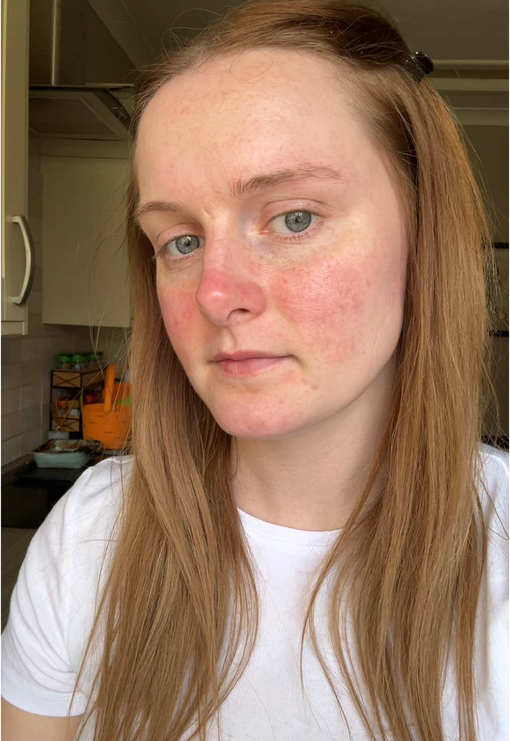 My Rosacea on a good day #skincare #rosacea #rosaceaskincare #rosaceacheck #redness #skin #rosycheeks #redface #facial 