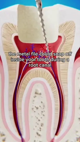 When Root Canal Tools Break Off 😨#LIVEIncentiveProgram #LIVEDebut #PaidPartnership 