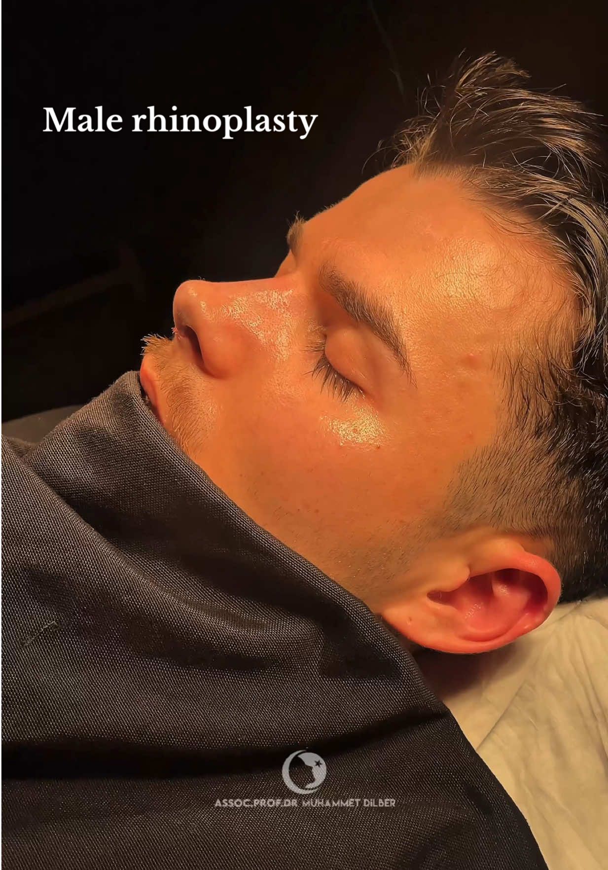 Male Rhinoplasty👌🏼 My dear patient from Bulgaria had a lot of breathing problems due to his crooked, arched and traumatic nose. His nose radix was low and he had a nose hump.  Now his new nose matches with his facial features and he breathes very well. He has a natural and yet, masculine nose with correct radix height.  Which actor does he look alike?  . . . . . . . . . . . . . . . . . . . . . . . . . . . . . . . . . . . . #rhinoplasty #crookednose 