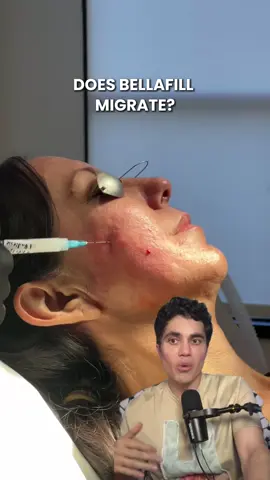 Does Bellafill migrate after it’s injected? Here’s what you need to know. Bellafill is a long-lasting filler often used in acne scar treatments and volume restoration. Unlike hyaluronic acid fillers, Bellafill does not draw in water, so it stays exactly where it is placed and does not shift over time. When I place Bellafill, I carefully and precisely position it under the scar tissue to create a supportive foundation that stays stable for years. In many cases, I use ultrasound to double-check placement after treatment, and we consistently see that Bellafill remains exactly where we intended it to be. This is one of the reasons Bellafill is such a powerful tool for restoring structure and smoothing out deep acne scars. Proper technique matters, and so does understanding the product’s unique behavior within the skin. Got questions about Bellafill, acne scar fillers, or what treatment might be right for you? Join me LIVE Monday through Thursday at 9 PM PST on TikTok, Instagram, YouTube, and Twitch. I’ll be sharing honest advice, real patient journeys, and treatment insights. 📞 Call/text: 949-336-7293 📱 WhatsApp: +1 (714)-860-6945 📍 20271 SW Birch St Suite 100, Newport Beach, CA 92660 #bellafill #acnescars #acnescartreatment #skinrestoration #doctorqazi #scarcorrection #collagenboost #longlastingfiller #fillertreatment #acnescarjourney #NewportBeach #aesthetics #naturalresults