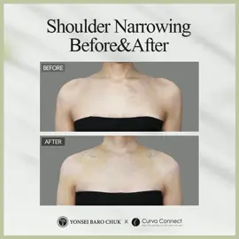 ✨ Shoulder Narrowing Transformation ✨ Swipe to see the difference! The clavicle reduction procedure helps create a more delicate and balanced shoulder line — ideal for those seeking a slimmer silhouette. 💫 This Before & After shows how subtle changes can make a big impact! 💡 Clavicle shortening = naturally refined proportions 👏 💬 More questions? Feel free to DM us anytime! #medicaltourism #medicaltourismkorea #kbeauty #cosmeticsurgerykorea #claviclereduction #shoulder #skeletalaesthetic #pelvicplasty #curvaconnect #NaturalBeauty #yonseibarochuk#yonseibarochuk #medicaltourism #kbeauty #cosmeticsurgerykorea #medicaltourismkorea #skeletalaesthetic #shoulder #curvaconnect #NaturalBeauty #pelvicplasty #claviclereduction